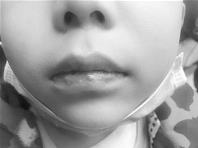 济南5岁娃输液疑遭紫外线灯照射近4小时 无法