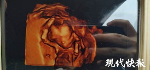 胎儿写真成性别鉴定灰色地带 专家:存在巨大风险