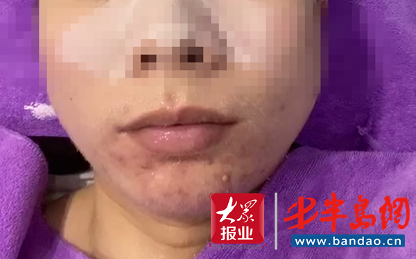 花了5000元做祛痘没效果室内还脏乱差？ 蕾特恩：顾客吃霸王餐