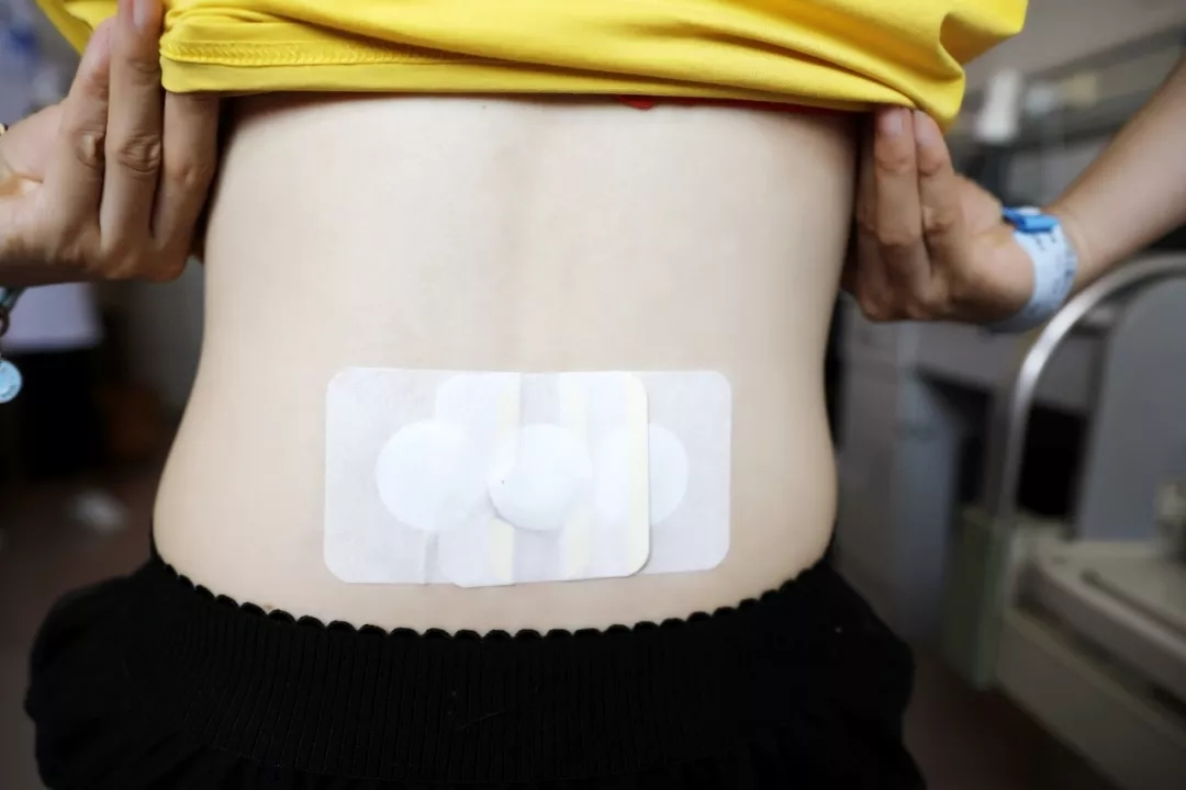 冬病夏治：西海岸新区中医医院儿科2020年三伏贴专病专治