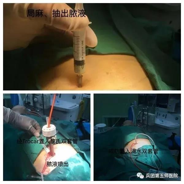 青大青大附院专家曹守根为新疆留下一支带不走的手术团队