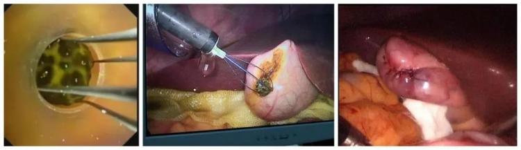 胆结石|不饿就不吃饭？小心胆结石找上你！