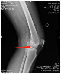 |技术|多处骨折病情复杂？关节镜下来点“小动作”，手术无需“大刀阔斧”！