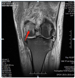 |技术|多处骨折病情复杂？关节镜下来点“小动作”，手术无需“大刀阔斧”！