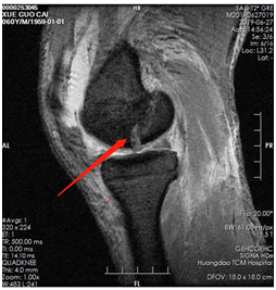 |技术|多处骨折病情复杂？关节镜下来点“小动作”，手术无需“大刀阔斧”！