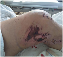 |技术|多处骨折病情复杂？关节镜下来点“小动作”，手术无需“大刀阔斧”！