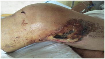 |技术|多处骨折病情复杂？关节镜下来点“小动作”，手术无需“大刀阔斧”！