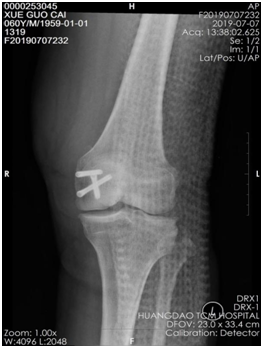 |技术|多处骨折病情复杂？关节镜下来点“小动作”，手术无需“大刀阔斧”！