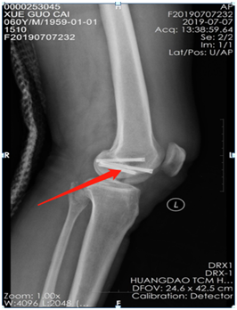 |技术|多处骨折病情复杂？关节镜下来点“小动作”，手术无需“大刀阔斧”！
