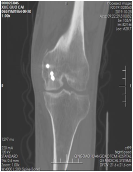 |技术|多处骨折病情复杂？关节镜下来点“小动作”，手术无需“大刀阔斧”！