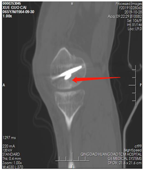 |技术|多处骨折病情复杂？关节镜下来点“小动作”，手术无需“大刀阔斧”！