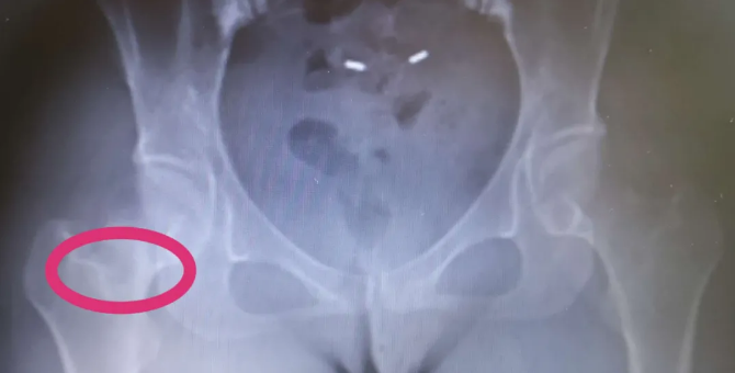 |即墨一女子右腿隐痛 竟然是骨头在自身吸收