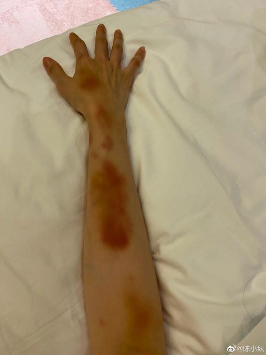 陈小纭晒手臂淤青照感慨要努力与张艺凡同框养眼