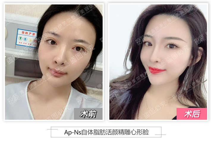自体脂肪填充|青岛伊美尔单文涛：选择Ap-Ns自体脂肪活颜精雕术，轻松摆脱老气！