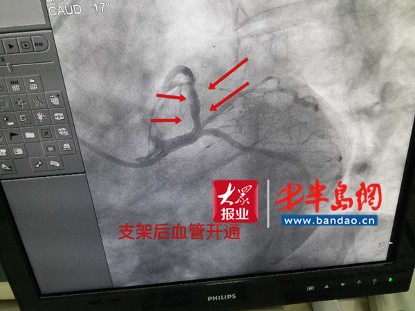 胶州|胶州：男子深夜突发心梗，紧急抢救挽回一命