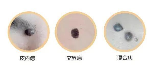 危险的痣长啥样?“ABCDE法则”教你辨别
