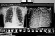 “人工肺”实现48小时无肺生存，维持患者生命直至移植手术