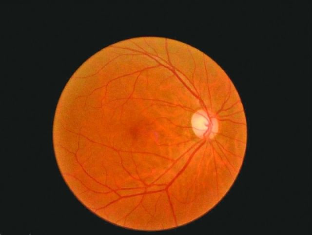 眼球上清晰有序的网状结构就是正常的眼动脉.