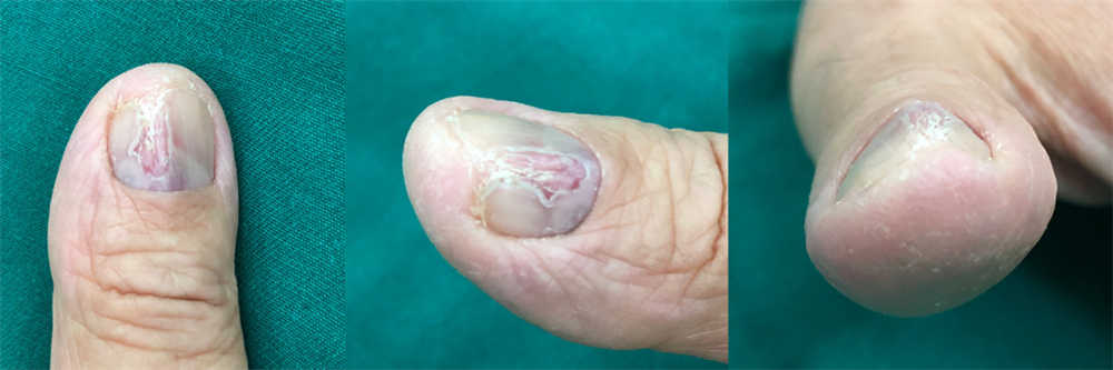 大拇指血管瘤图片图片