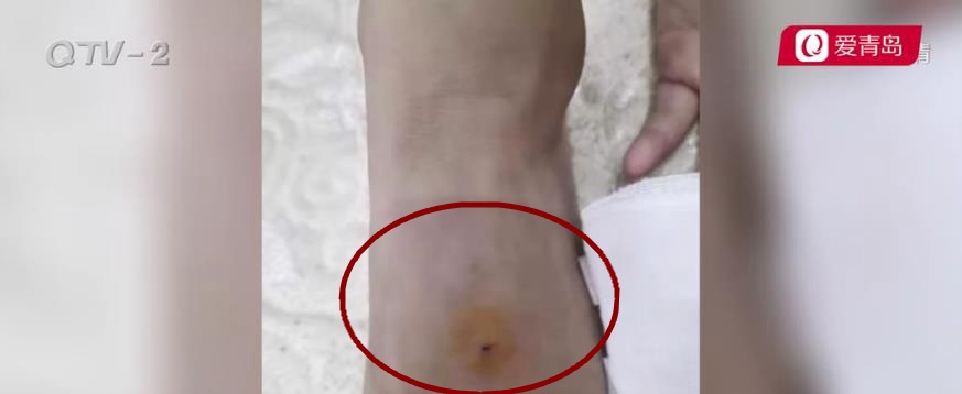 青岛一小学生将铅笔扎进8岁女同学脚背 其他家长:这类行为不是第一次