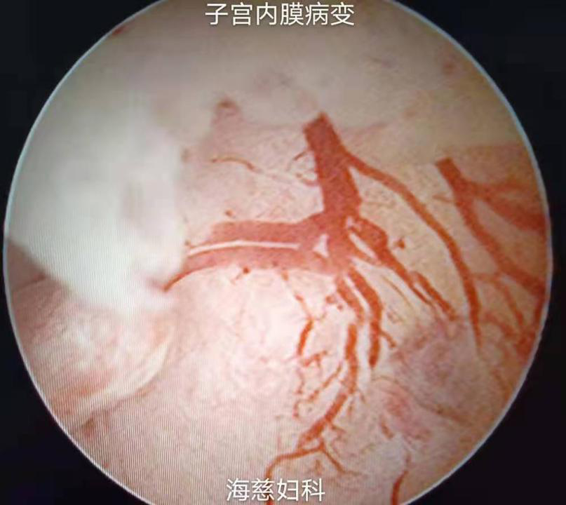 子宫内膜癌作为女性生殖系统三大常见恶性肿瘤之一,近年来发病率有