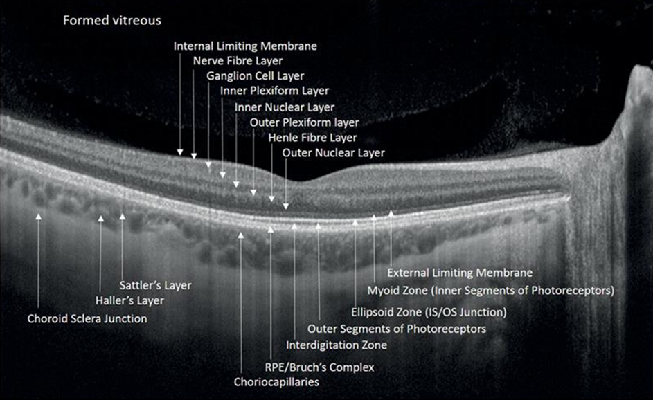 眼睛的这种光学特点,使oct技术在眼科检查得到广泛应用,特别是在玻璃