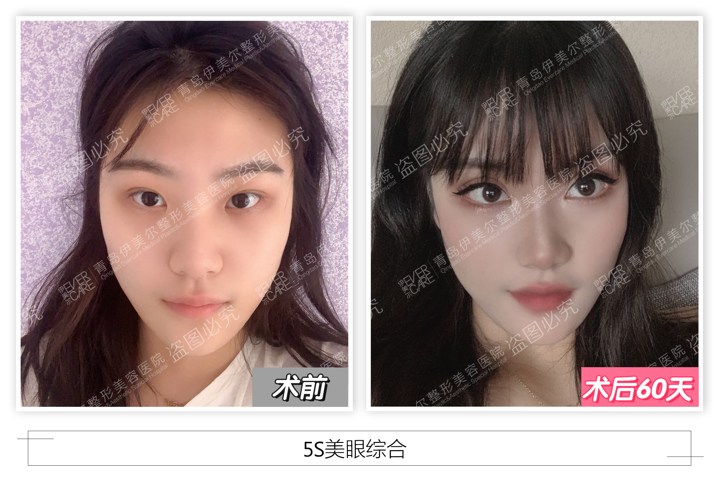 综合美眼正当时青岛伊美尔5s美眼综合打造硬核消费指南