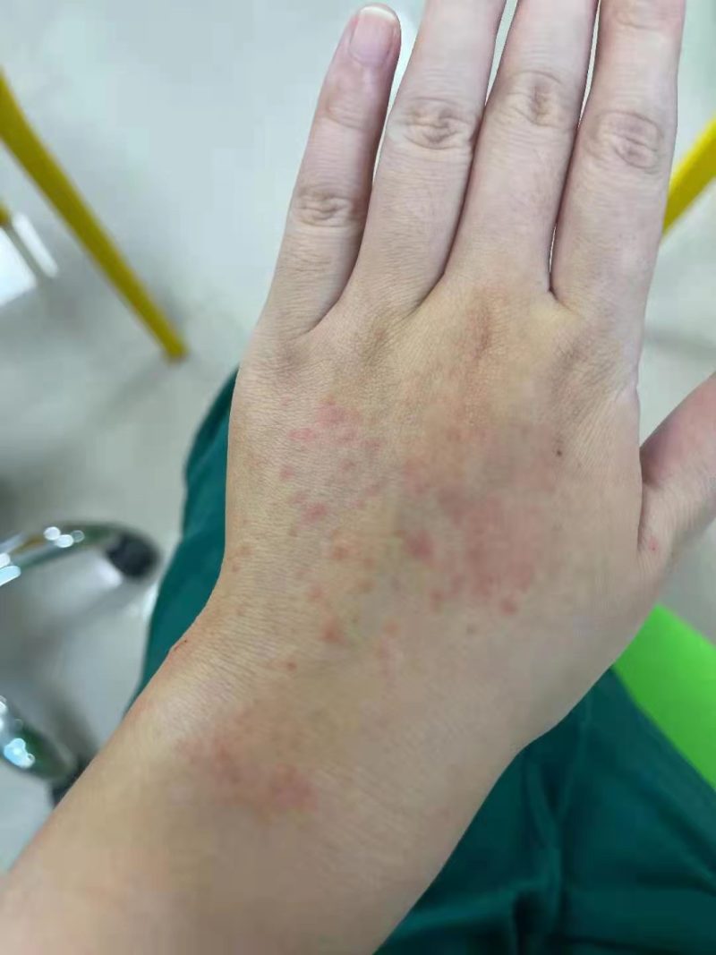 口含硝酸甘油,手上长满皮疹.青岛第三人民医院完成56467份样本检测