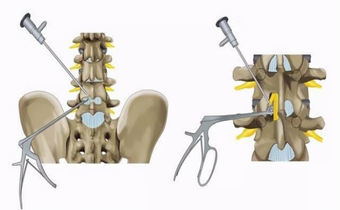 3.椎间孔镜也可以做椎间管狭窄,有必要再开展ube?