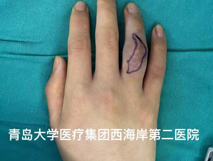 右手无名指功能受损求医无门，青大医疗集团西海岸第二医院两期手术助患者重获新生-半岛网