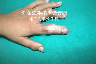 显微巧塑指尖新生！青岛大学医疗集团西海岸第二医院田茂元、郭子文团队为左示指指尖三度缺损患者成功再造手指-半岛网